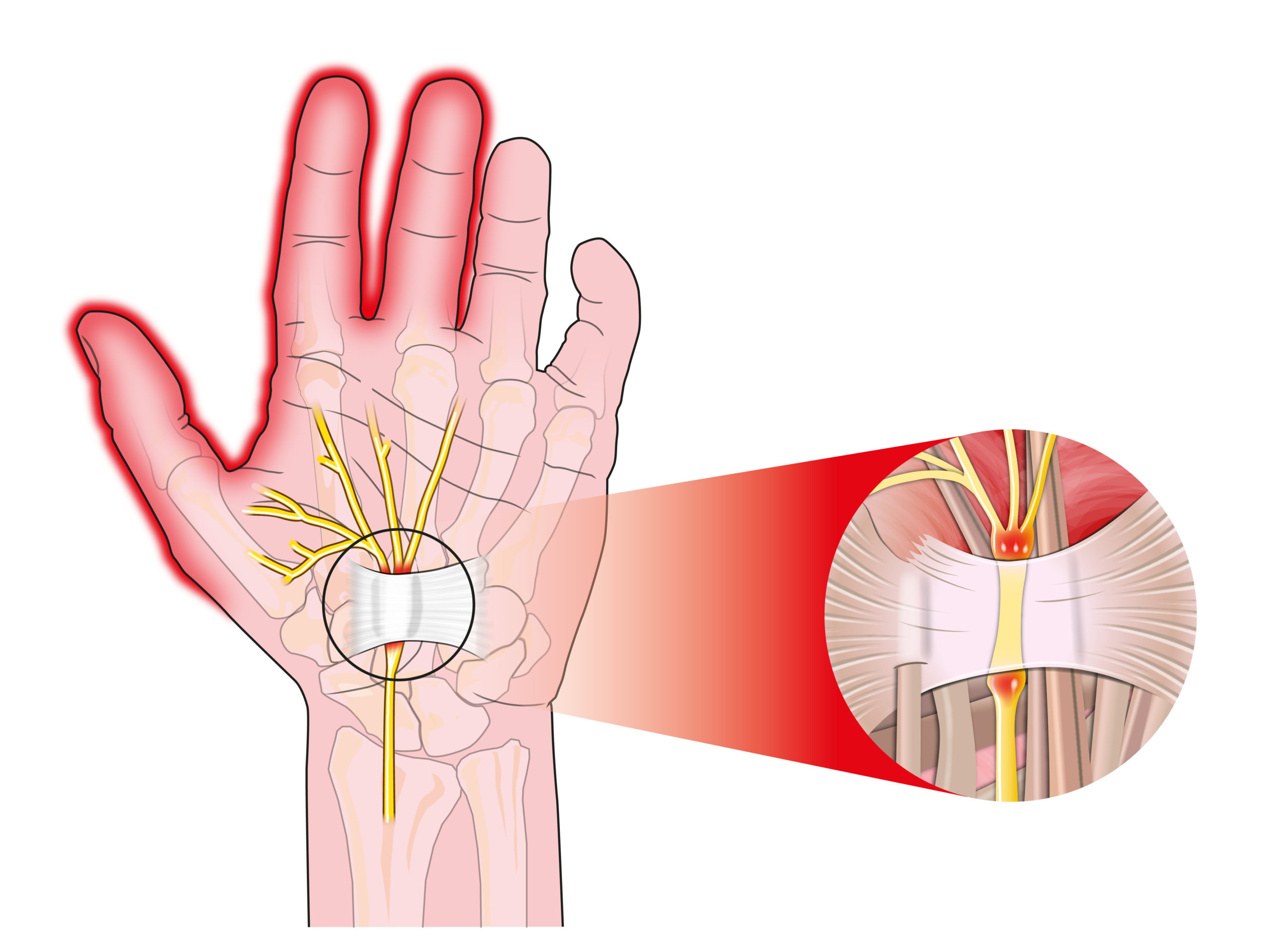 THINK YOU HAVE CARPAL TUNNEL SYNDROME? TAKE THESE 3 SIMPLE HOME TESTS -  Hess Physical Therapy